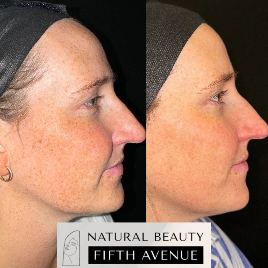 Before and after profile view showing improved skin tone evenness from medical dermatology treatment